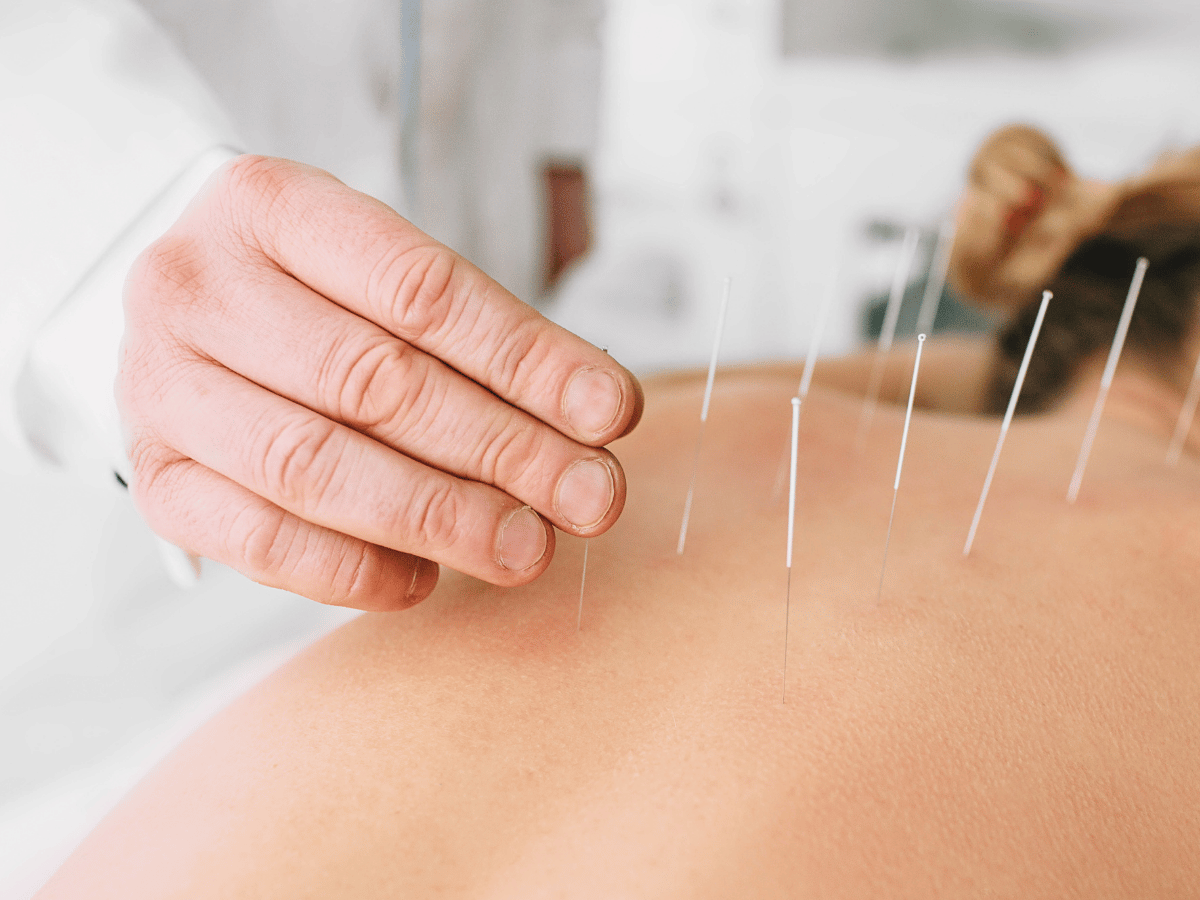 Die Frau bekommt Akupunktur am Rücken