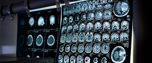 Europäischer Tag der Epilepsie