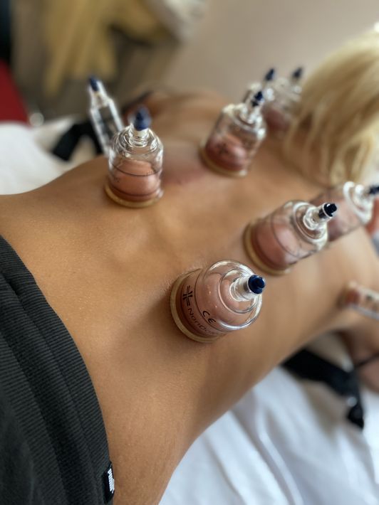 "Schröpfen: Eine bewährte Heilmethode der Traditionellen Chinesischen Medizin"